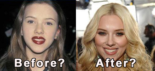 Celebrity cosmetic surgery: Scarlett Johansson