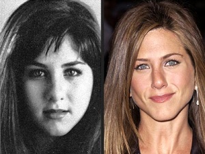 Celebrity cosmetic surgery: Jennifer Aniston