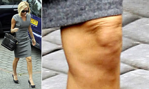 Celebrity diet: Victoria Beckham busted with cellulite