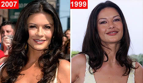 Celebrity cosmetic surgery: Catherine Zeta-Jones