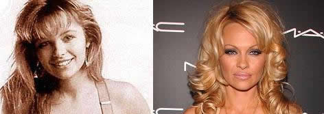 Celebrity cosmetic surgery: Pamela Anderson and cosmetic surgery